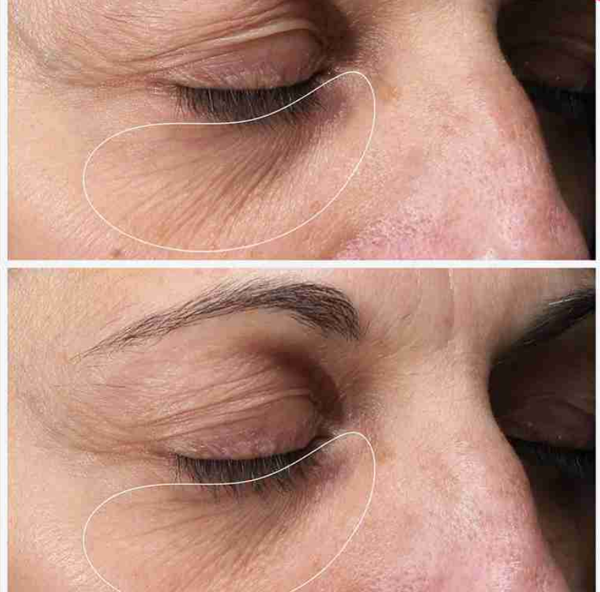 کرم دور چشم حلزون کوزارکس