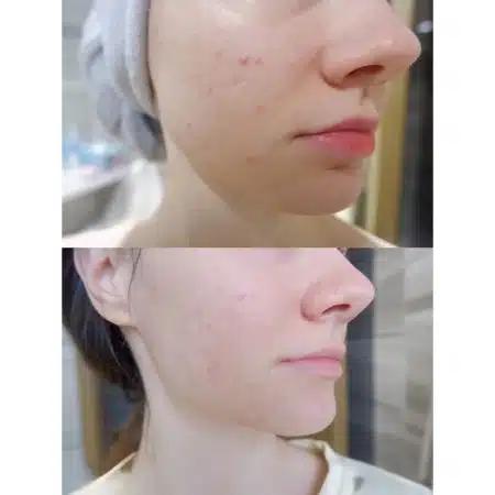 سرم نامبوزین شماره ۵